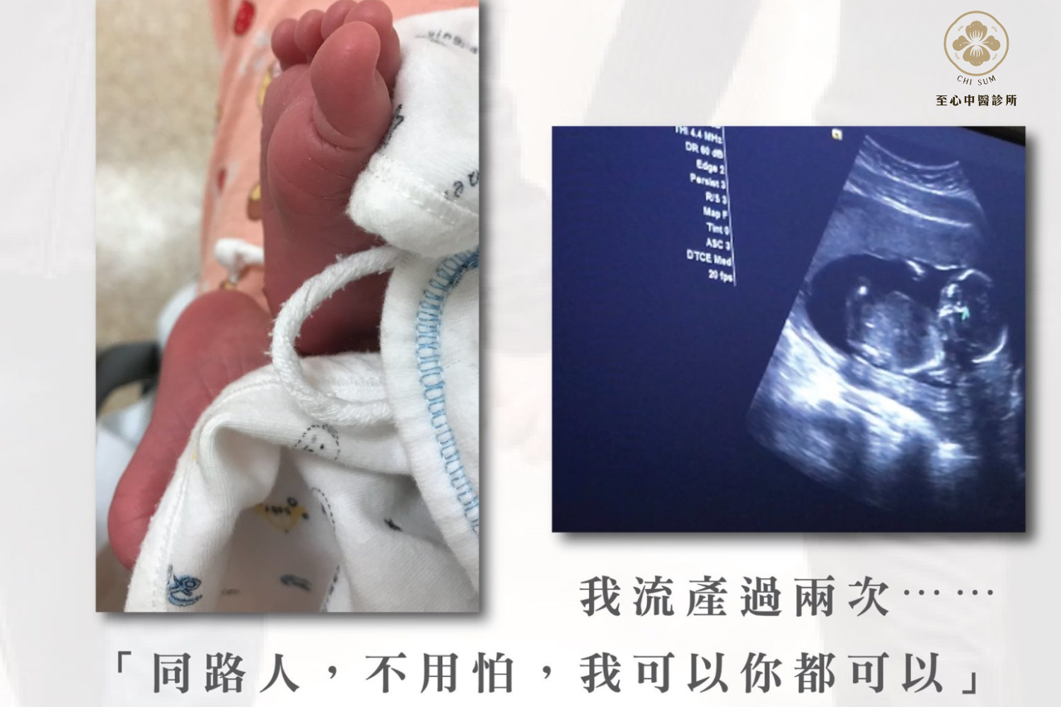 38歲【經歷流產2次】 終於成功懷孕